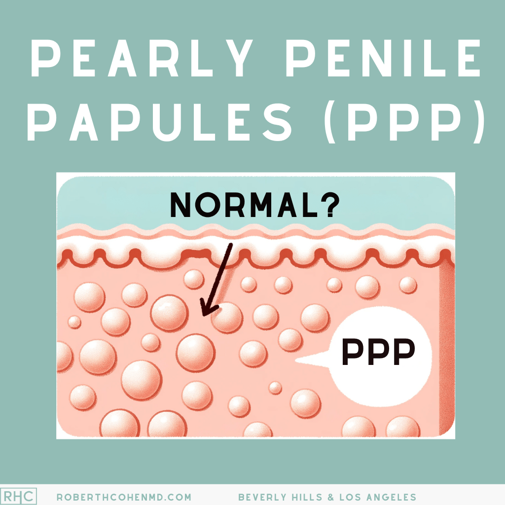 Pearly Penile Papules (PPP)