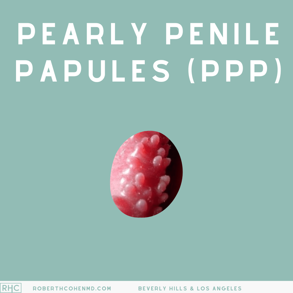 Bumps On Your Penis Understanding Pearly Penile Papules PPP Robert Bumps On Your Penis Understanding Pearly Penile Papules PPP Robert