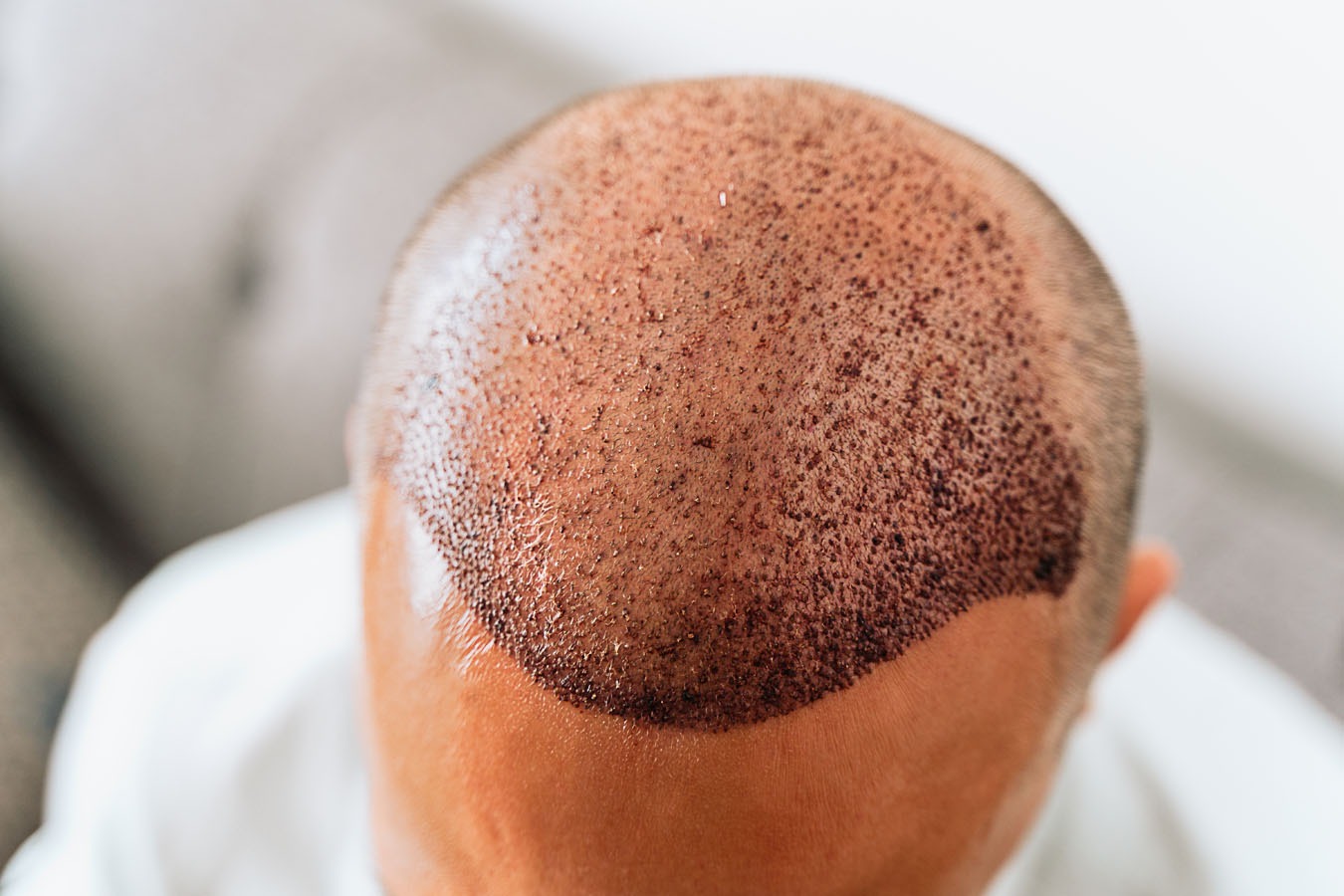 PRP Therapy for Receding Hairlines in Men