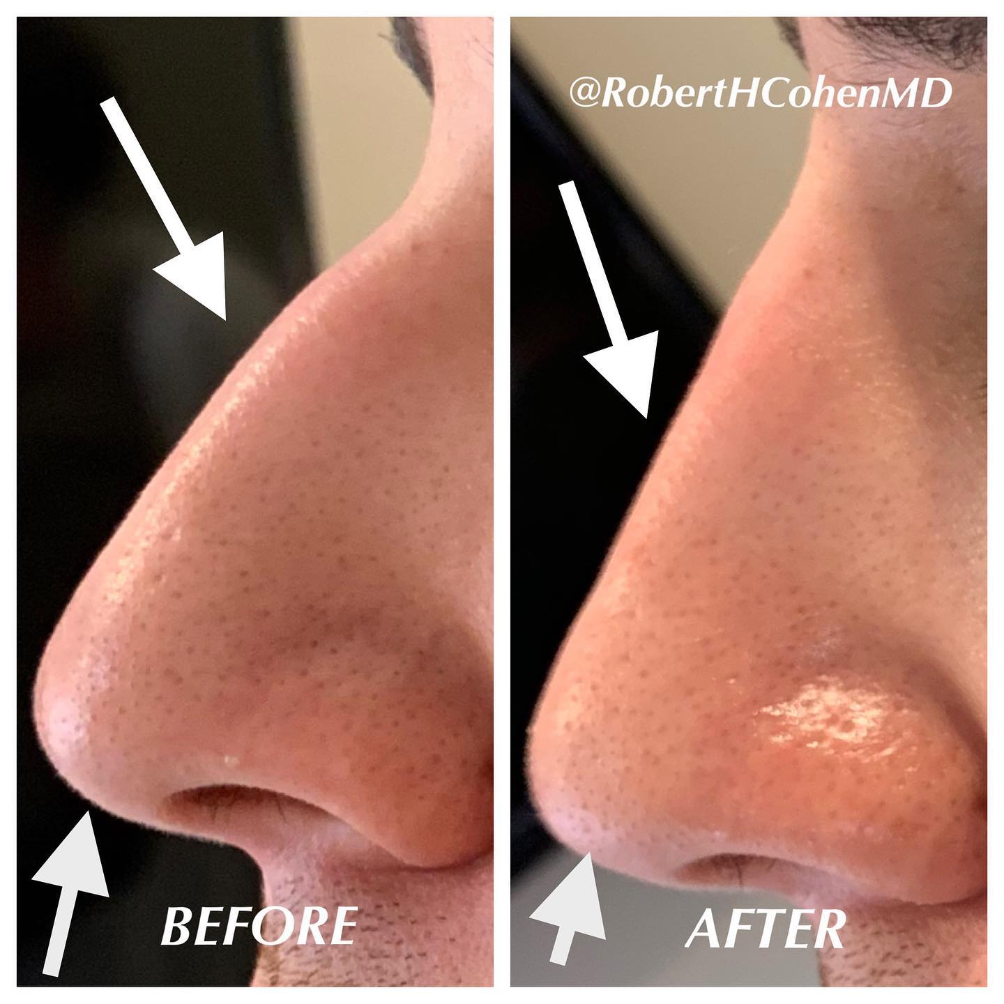 Non-Surgical Rhinoplasty Fillers, Neurotoxins & Steroids