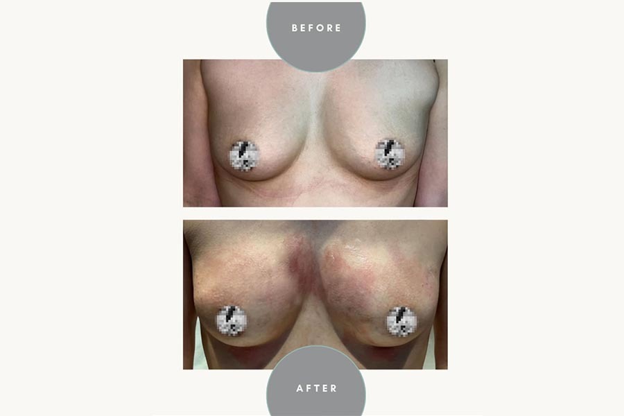 Breasts before-after